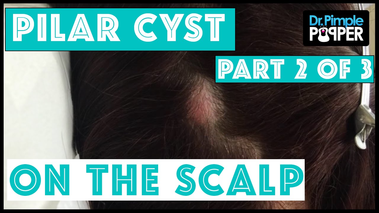 A Nice Pilar Cyst, her second of three to be excised