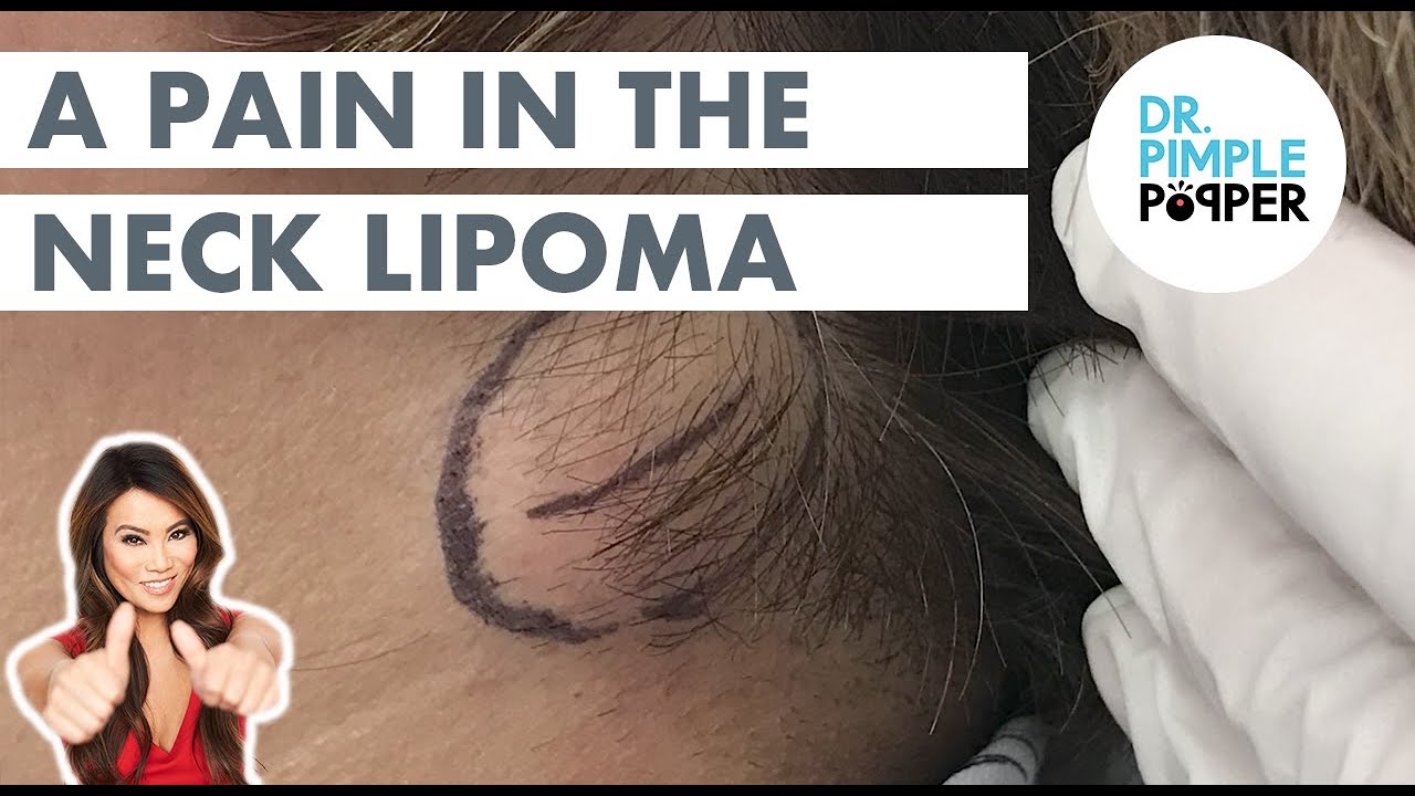 A Pain in the Neck Lipoma