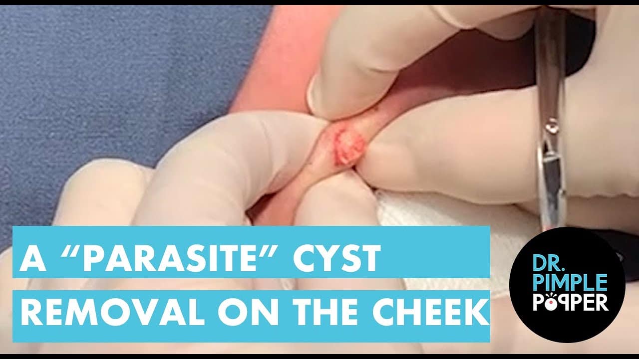 A "Parasite" Cyst Removal