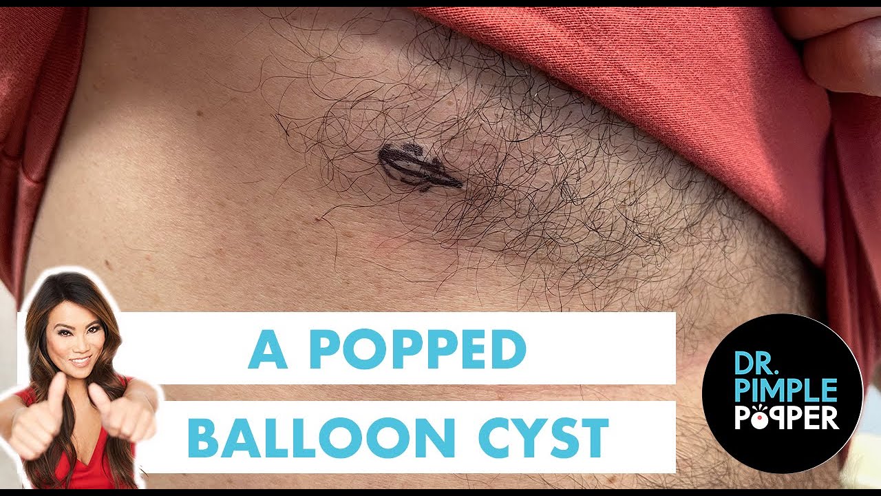 A Popped Balloon Cyst
