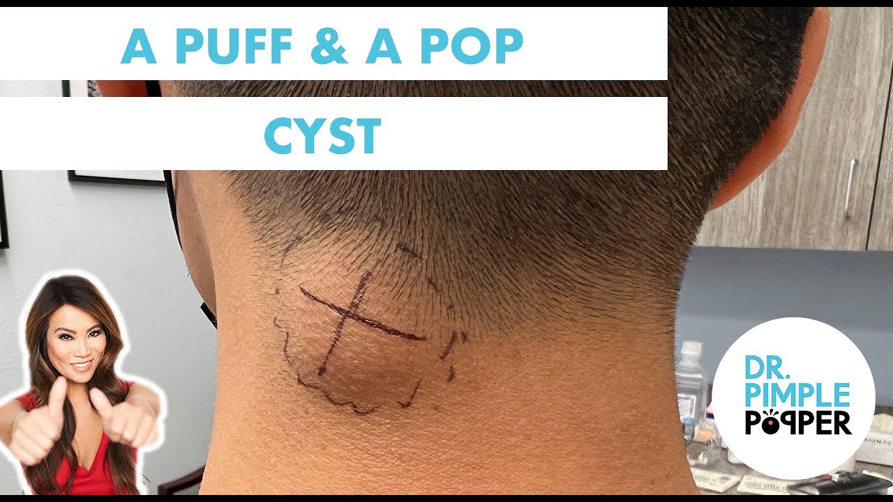 A Puff & A Pop Cyst