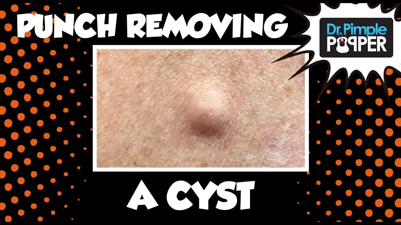 A Punch Removal of a Cyst! With Dr Pimple Popper
