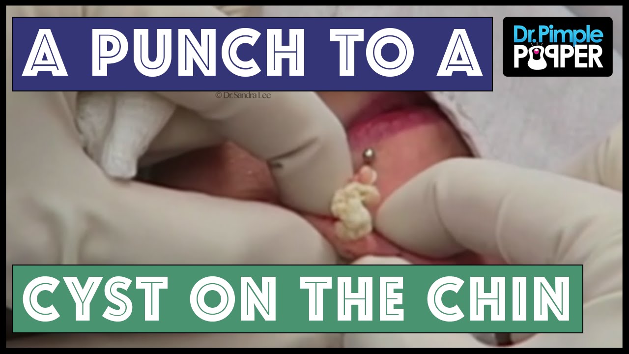 A Punch to a Cyst on the Chin!