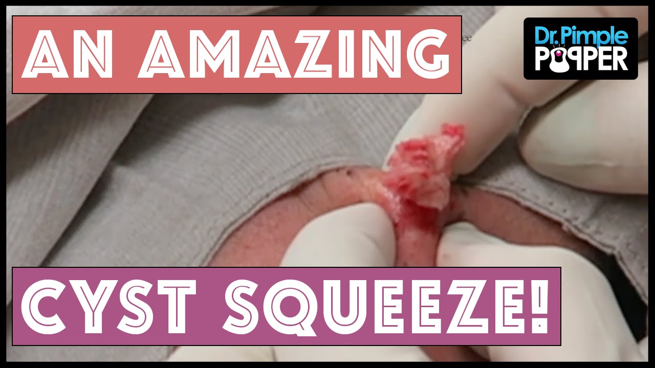 A Really AMAZING Left Cheek Cyst Squeeze!!