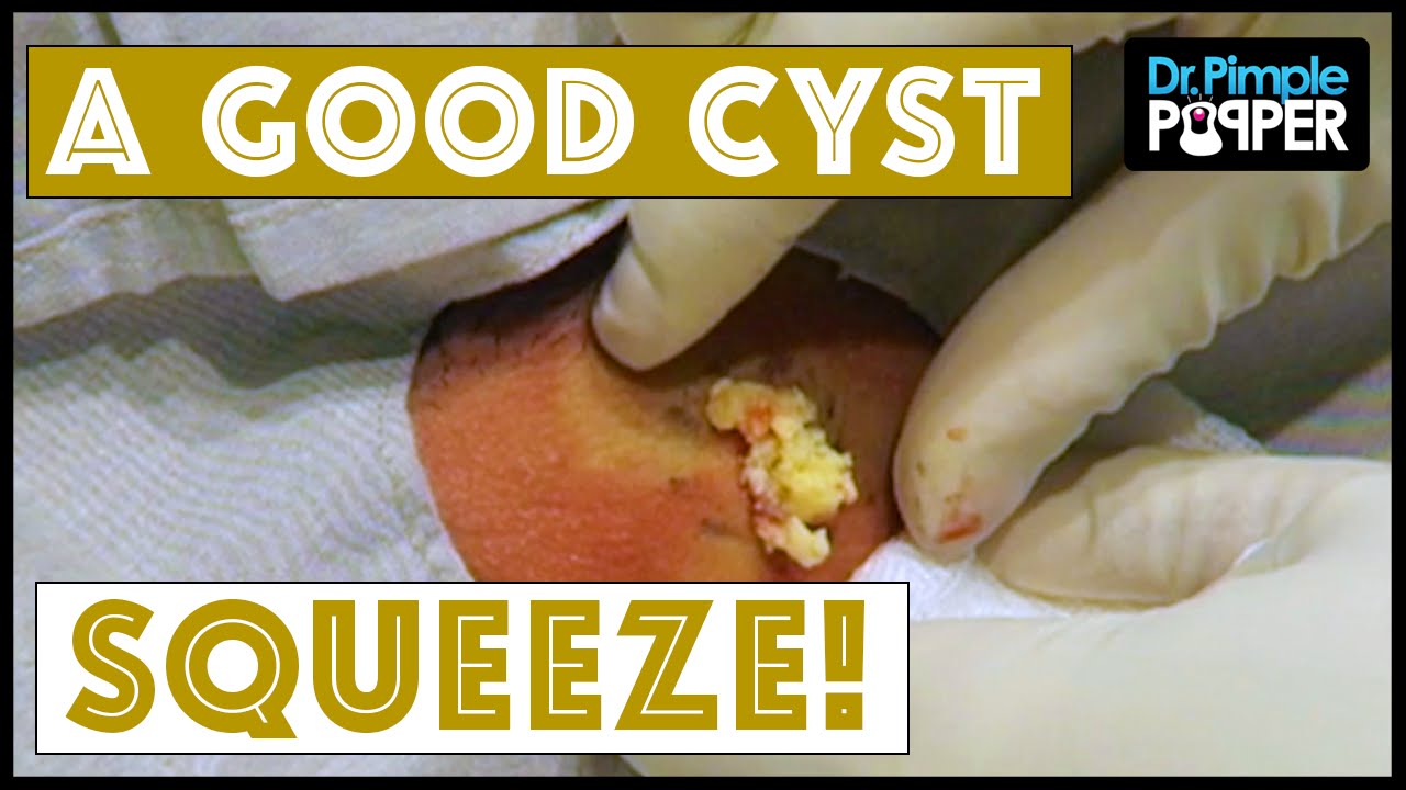 A really BIG Cyst SQUEEZE on the Neck