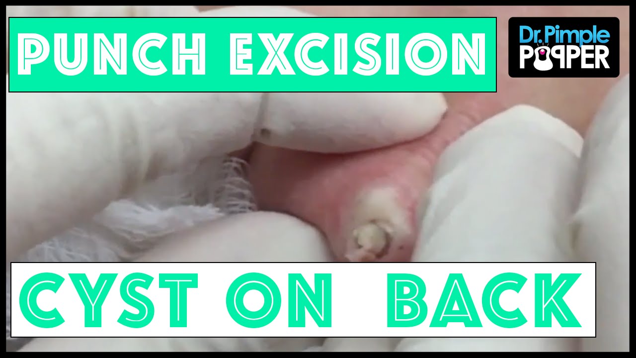 A recurrent cyst removed via punch biopsy tool