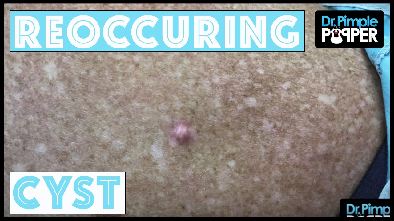 A Reoccuring Cyst that needed a Good Curette!