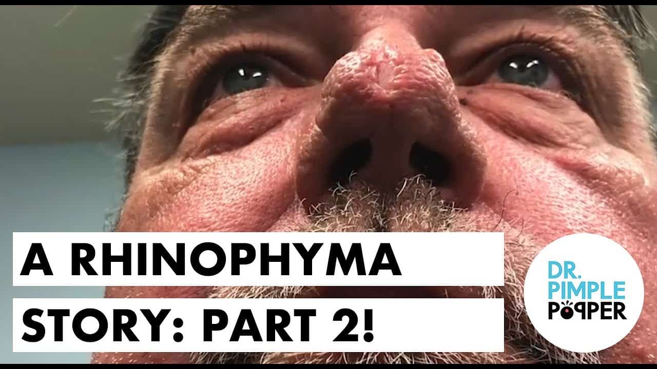 A Rhinophyma Story: Part 2