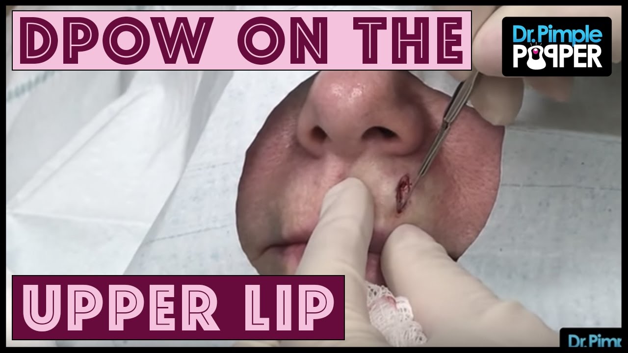 A scar & Dilated Pore of Winer on the Upper Lip