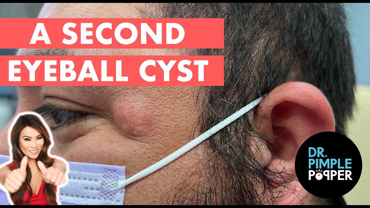 A Second Eyeball Cyst