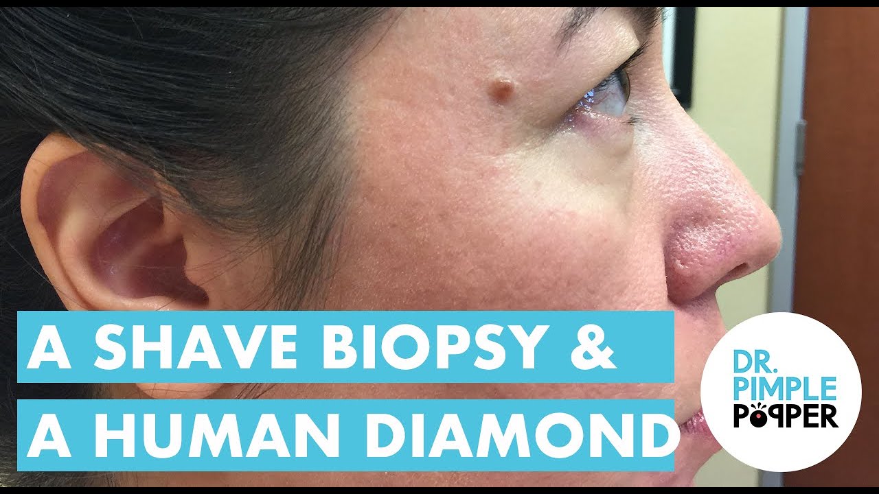 A Shave Biopsy and a Human Diamond!