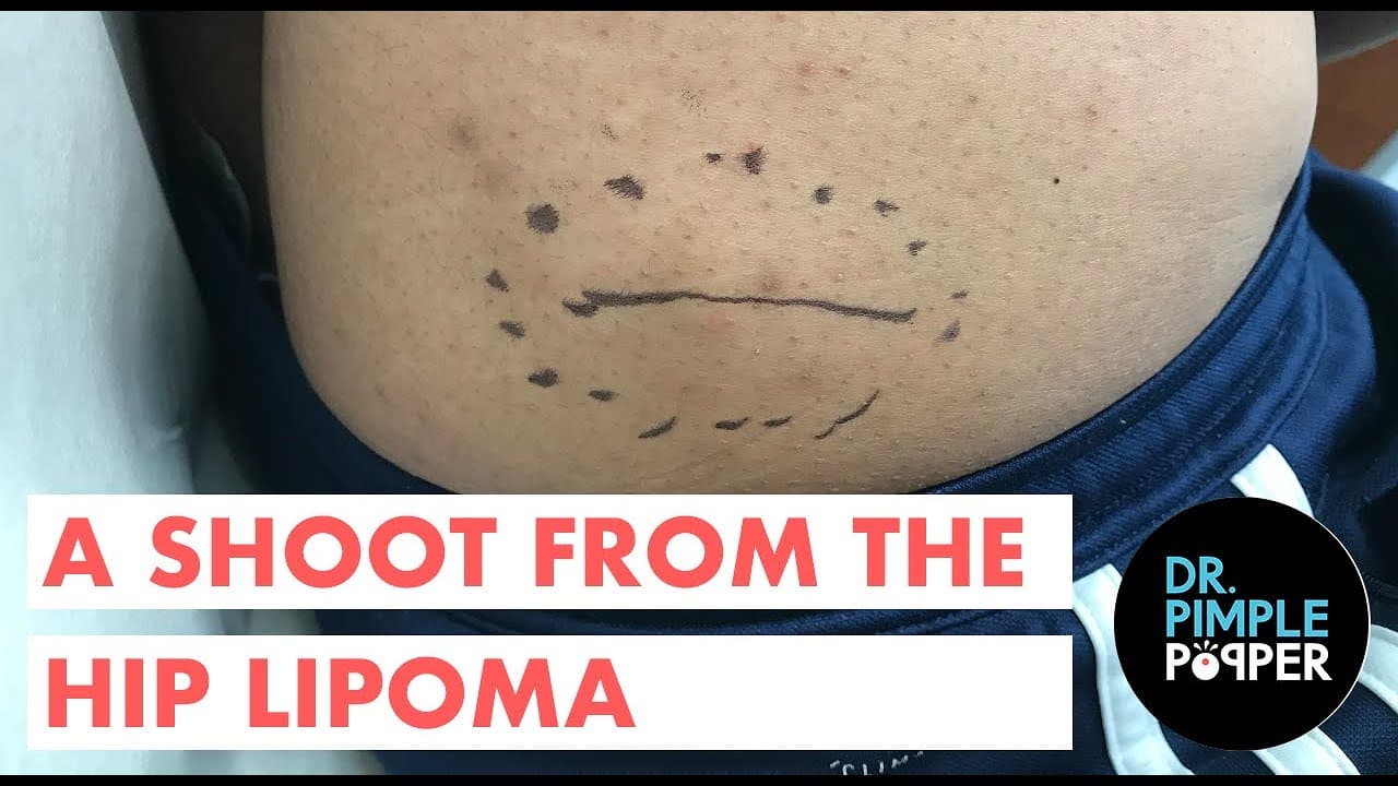 A Shoot From the Hip Lipoma