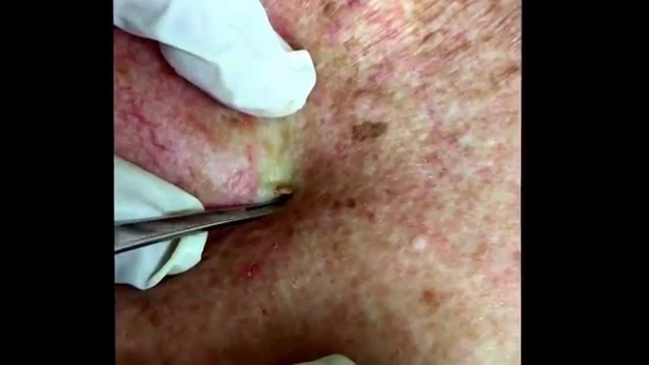 A short video of a loooong blackhead.  For medical education- NSFE.