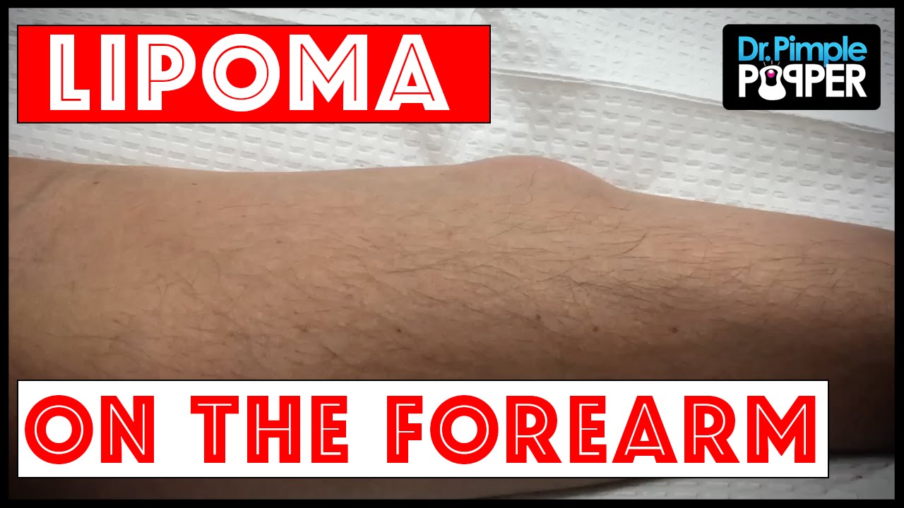 A Single, Noticeable Lipoma on Forearm