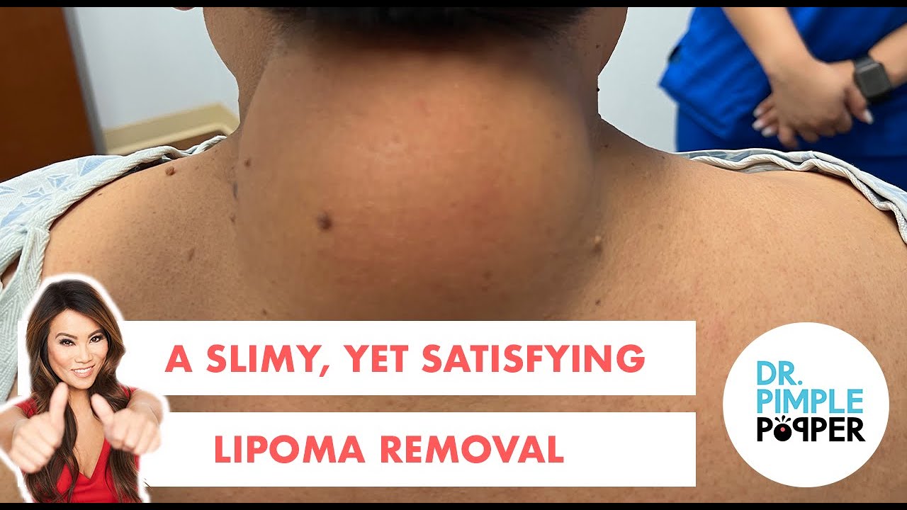 A Slimy, Yet Satisfying Lipoma