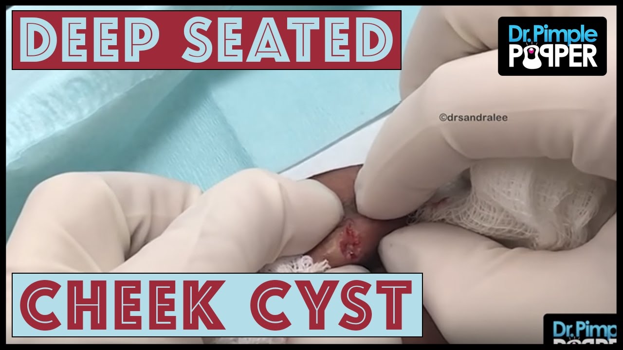 A Small, but Believable Cyst