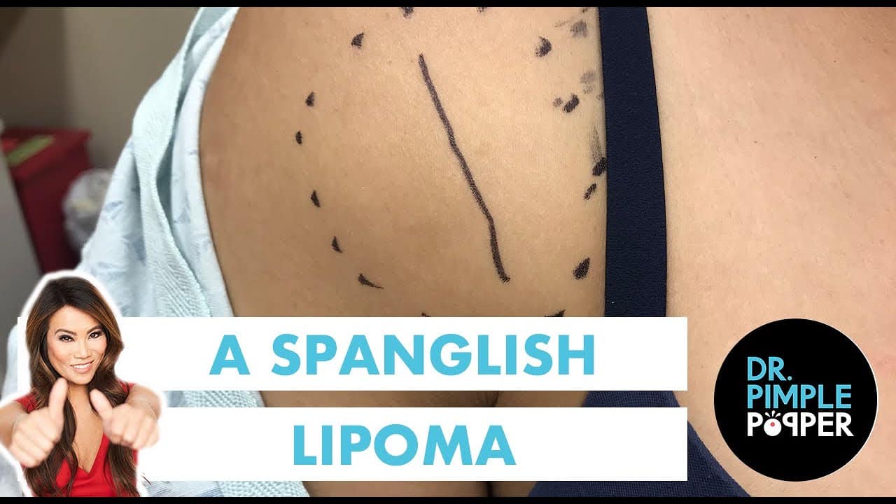 A Spanglish Lipoma
