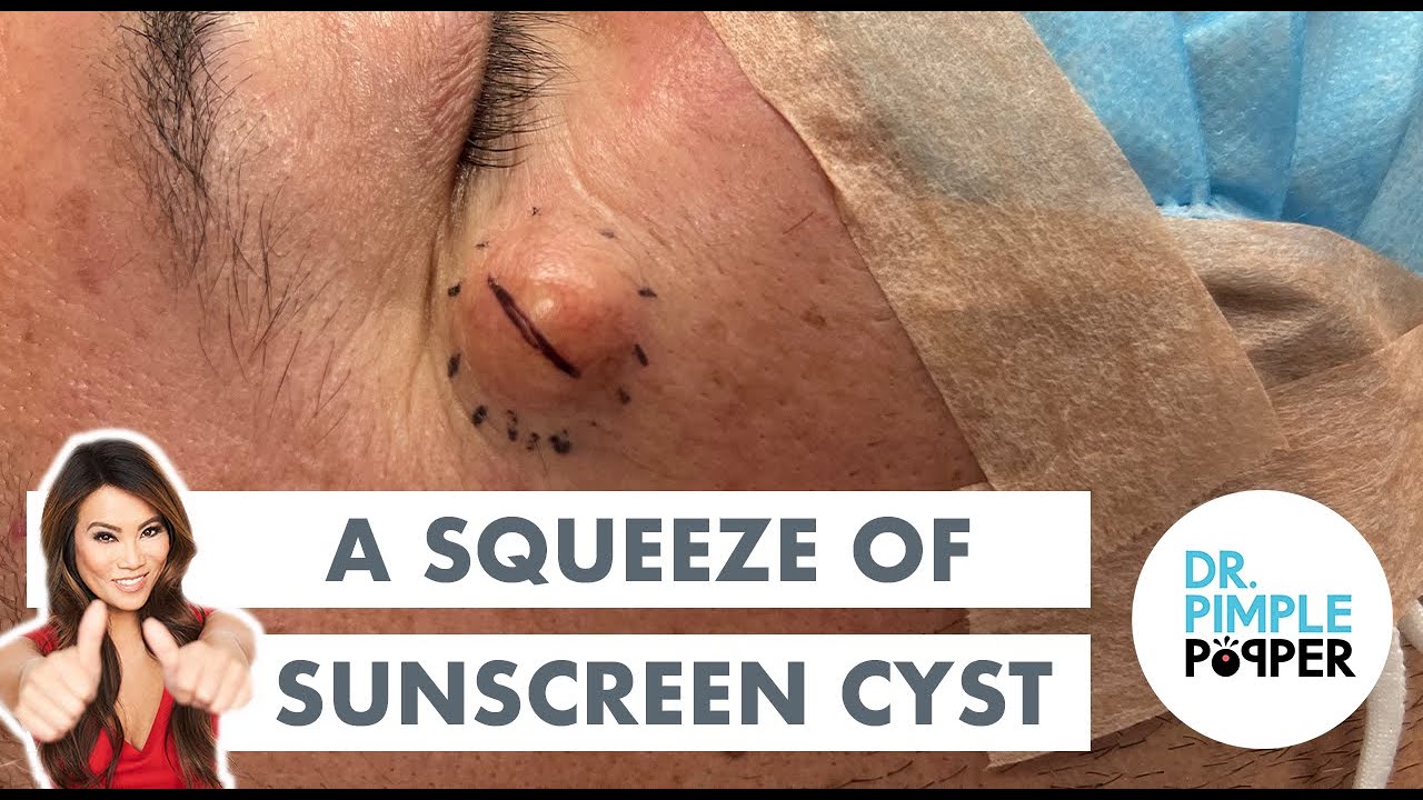 A Squeeze of Sunscreen Cyst