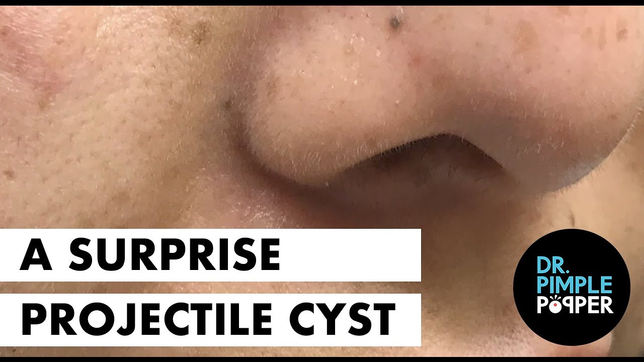 A Surprise Projectile Pilar Cyst