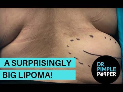 A Surprisingly BIG Lipoma!