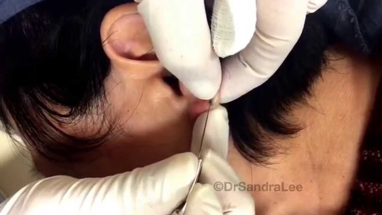 A sweet and simple extraction.