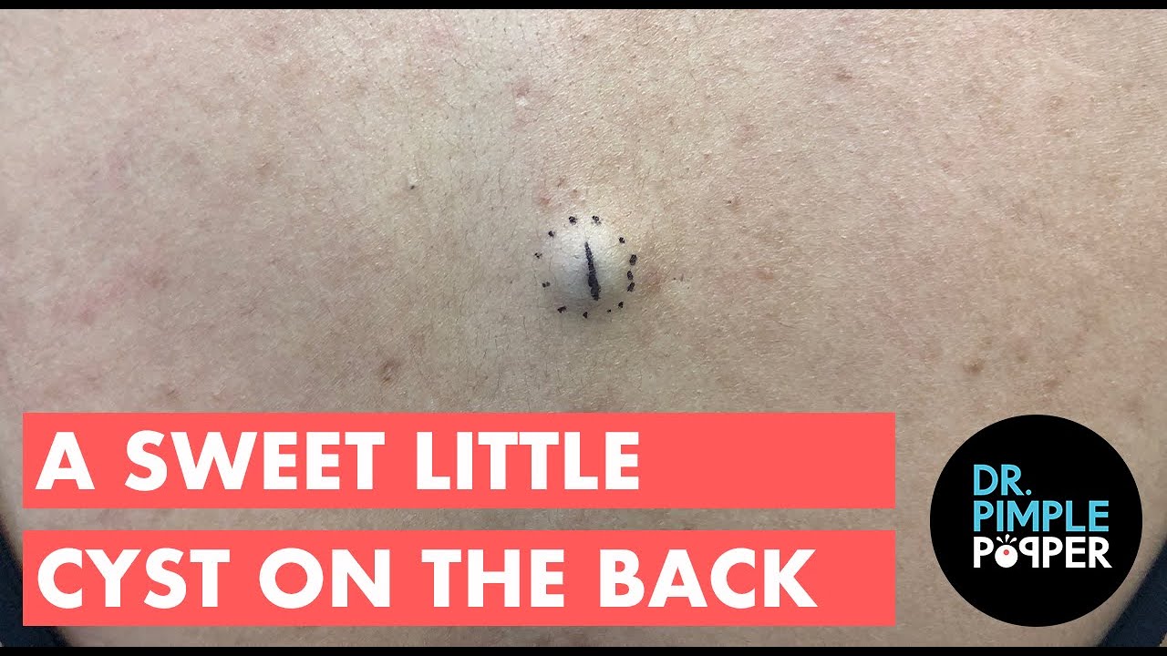 A Sweet Little Cyst on the Back