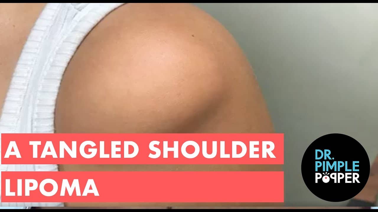 A Tangled Shoulder Lipoma