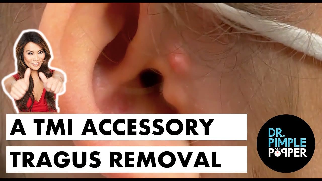 A TMI Accessory Tragus Removal