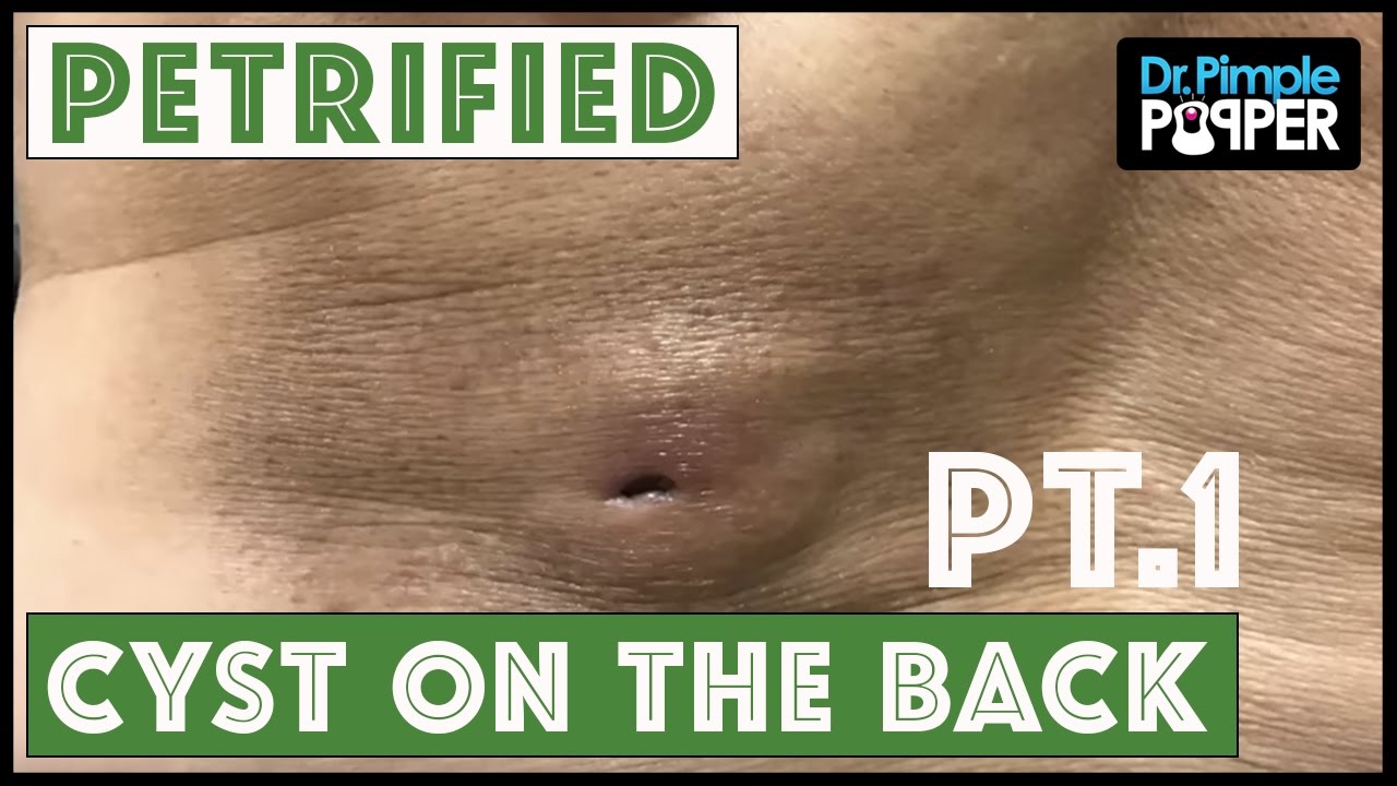 A Truly PETRIFIED Cyst: Part 1!