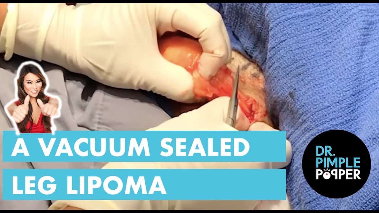 A Vacuum Sealed Leg Lipoma