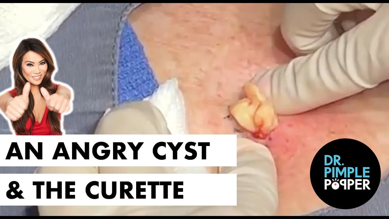 A Very Angry Cyst Meets the Curette!