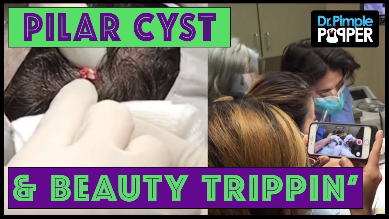 A very META Pilar Cyst POP: Dr Pimple Popper & Beauty Trippin’