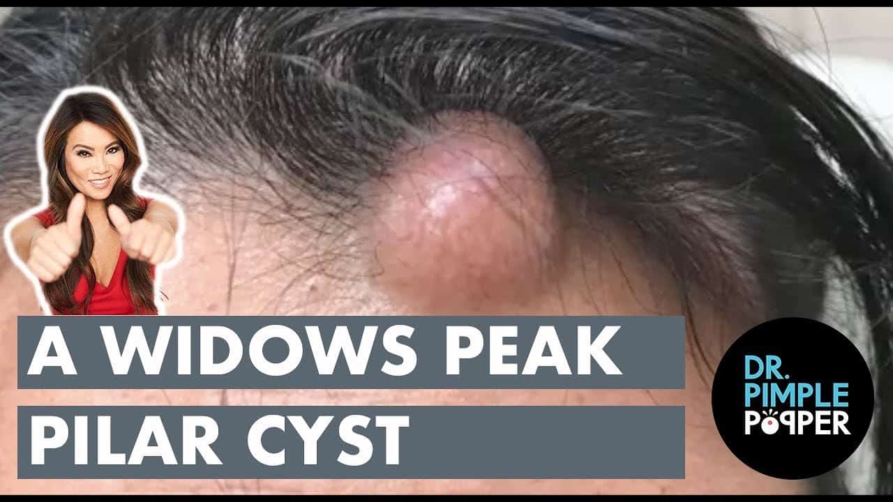 A Widow’s Peak Pilar Cyst