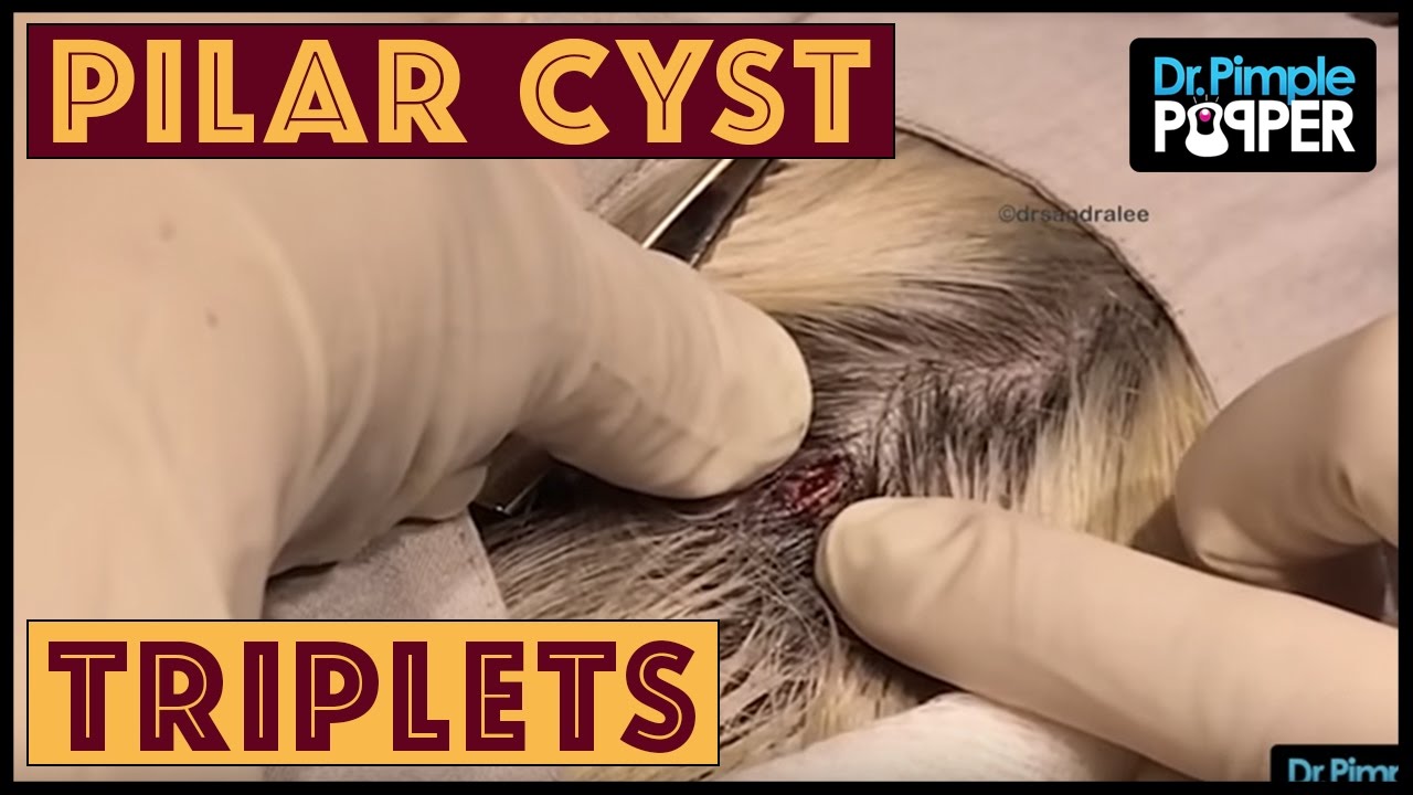 A Zero for Three Pilar Cyst Squeeze