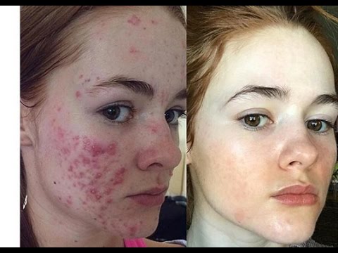 ACCUTANE AND DERMAROLLING EXPERIENCE | IG LIVE FROM MYFACESTORY