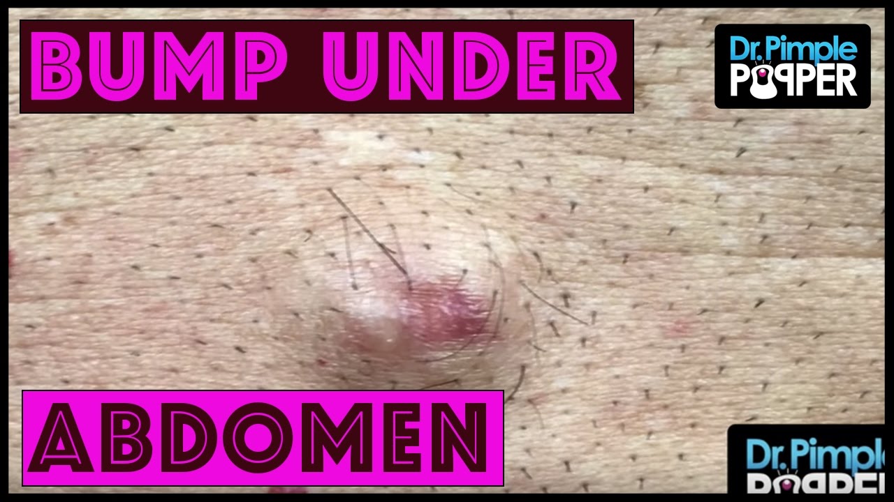 Achou Que Eu Não Removeria Nada Hoje… Logo Eu, Dr. Pimple Popper 🇧🇷  A Brazilian Born Bump Excised