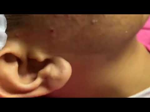 Acne 484 I cysts popping at home