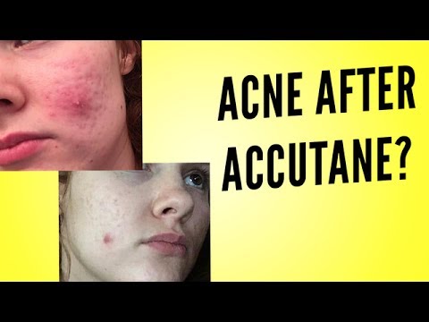 ACNE AFTER ACCUTANE?