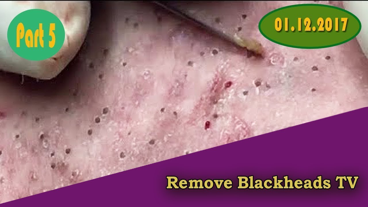 Acne And Blackhead, popping blackheads,cysts blackheads removal on face Part5