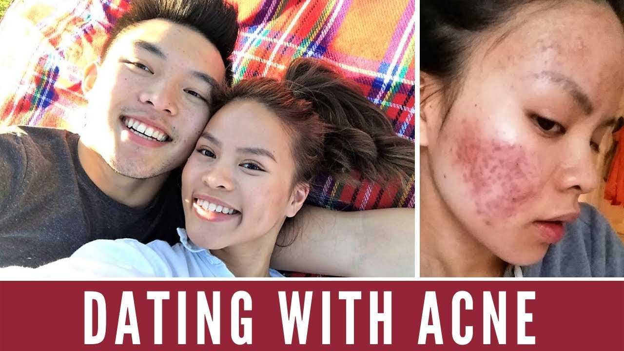 Acne and Dating | My Boyfriend Said What?!😲