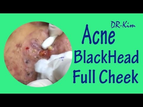Acne Blackheads, Deep Blackheads, Cyst Treatment, Satisfying Popping Pimples-Blackheads Removal