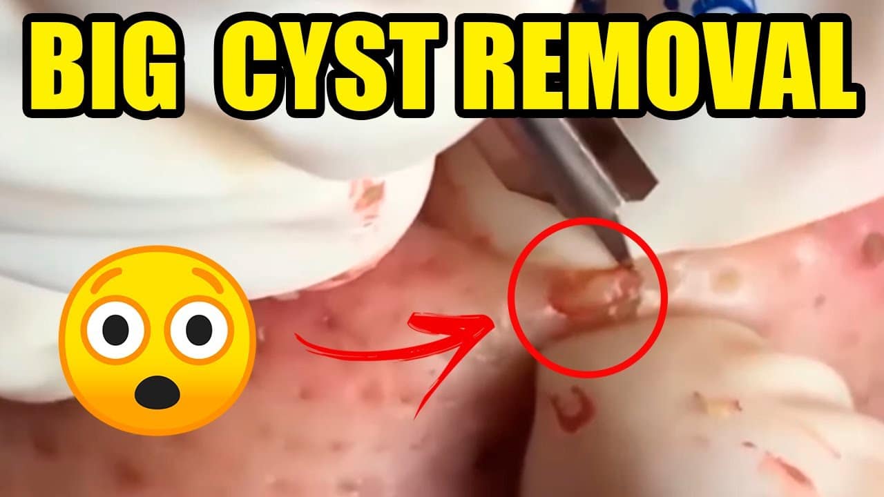 Acne Blackheads Extraction Whiteheads Removal Blackheads [Big Cystic Pimple Popping]