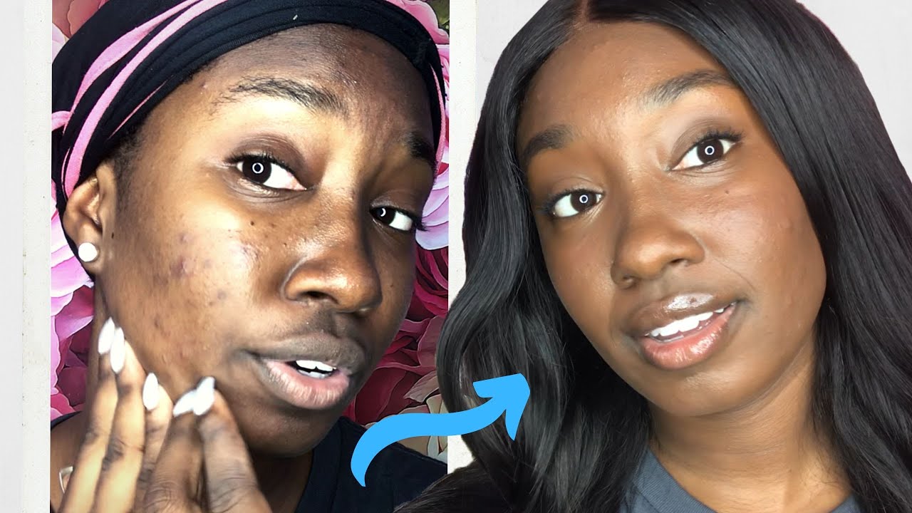 Acne Coverage Makeup Routine ✨