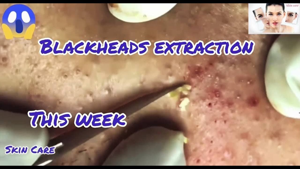 Acne extraction this week , blackheads remove ,pimple popping #32
