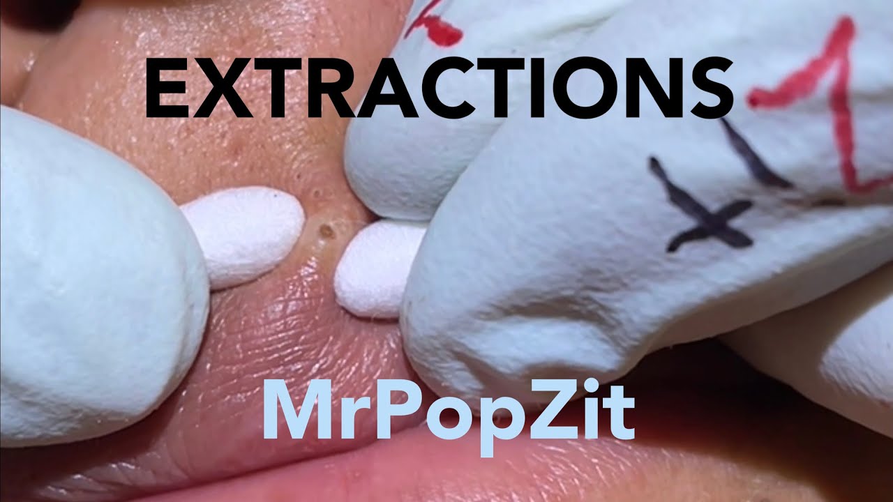 Acne Extractions.Blackheads for days 5. Nothing but the pop.Creamy pore pops. Blackheads,whiteheads