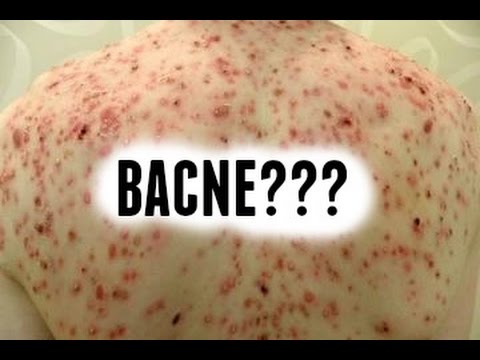 ACNE ON YOUR BACK? BACNE?? ACNE BODY MAPPING #TMITUESDAYS