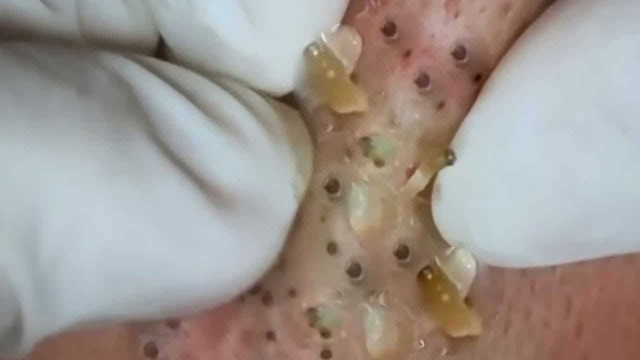 Acne removal and extraction from the Earn – blackheads pimple popping | blackhead removal