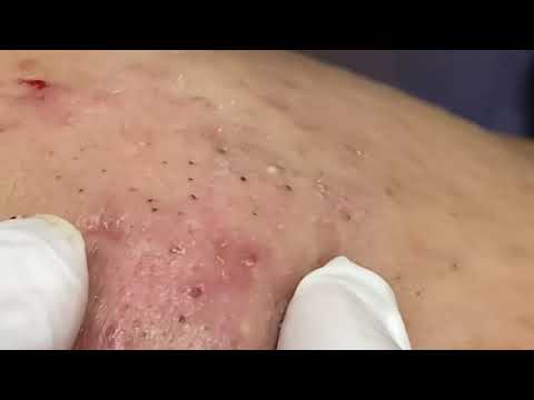 Acne Removal, Blackhead Extraction, Whitehead Removal, Pimple Popping| Sandra Lee|