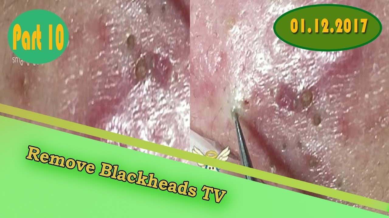 Acne skin,popping blackheads,cysts blackheads removal on face (Part 10)