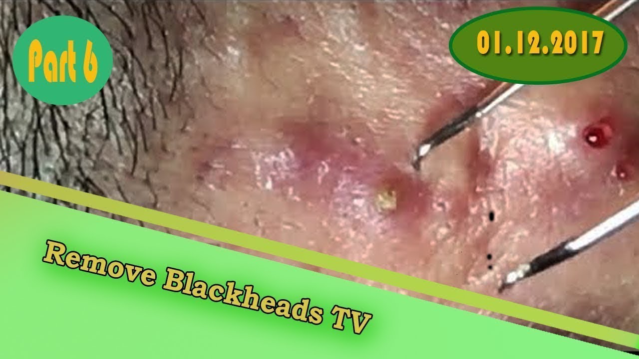 Acne skin,popping blackheads,cysts blackheads removal on face Part 8